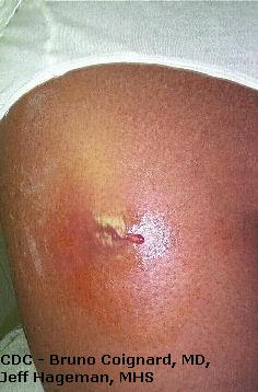 MRSA Pictures / Staph Infection Pictures/Graphic Images ...