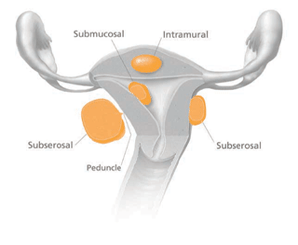 illustation of possible locations of uterine fibroids in and surrounding the femake reproductive system