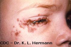 Zdjęcie z CDC wirusowego zakażenia skóry - Herpes gladiatorum, miejscem zakażenia jest oko