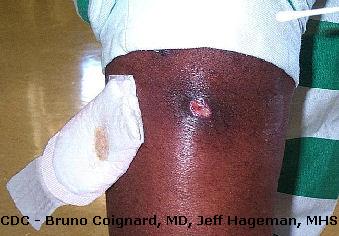 MRSA infection on arm