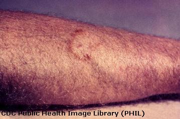 Tinea Versicolor in Adults: Condition, Treatments, and ...