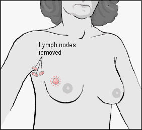 Diagram of Lumpectomy