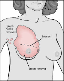 Diagram of Modified Radical Mastectomy